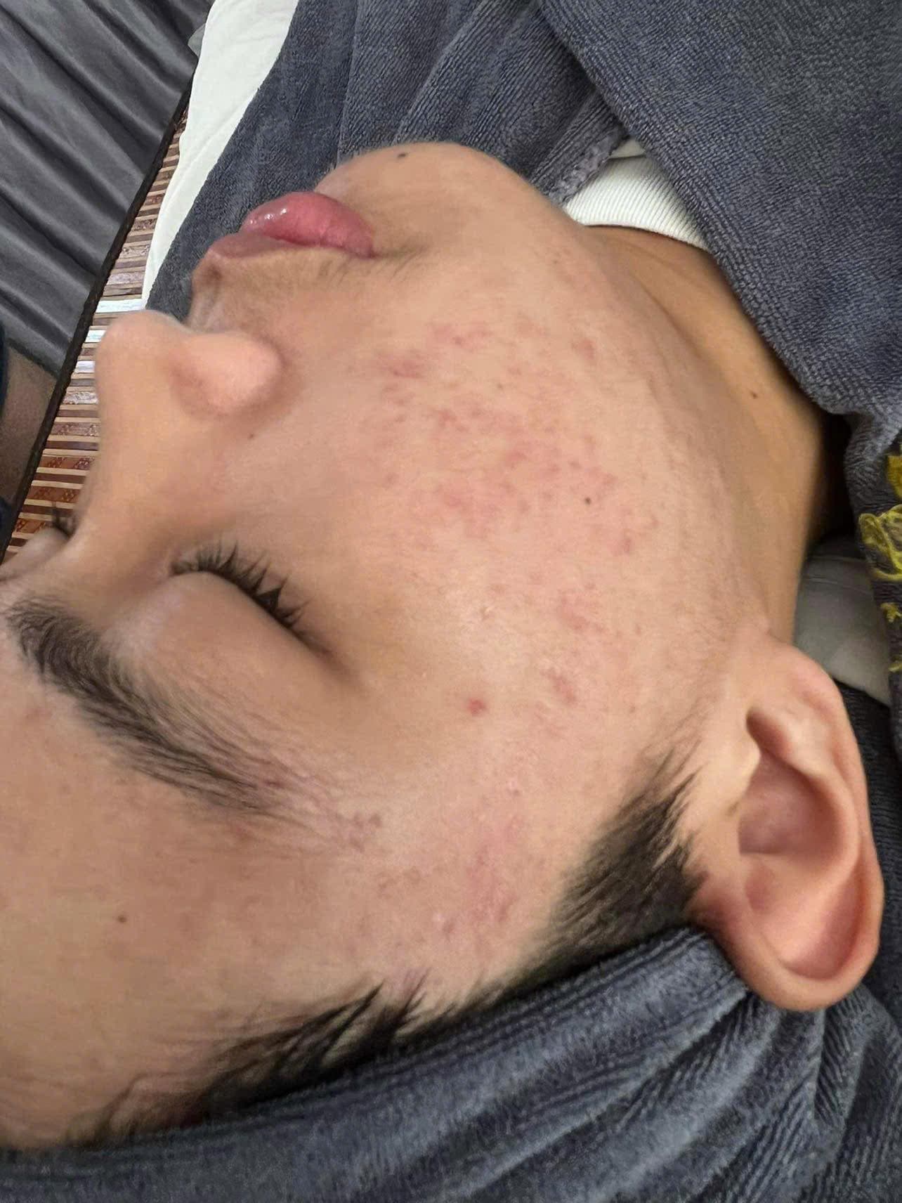 Same cheek after skin rejuvenation care plan with smoother texture