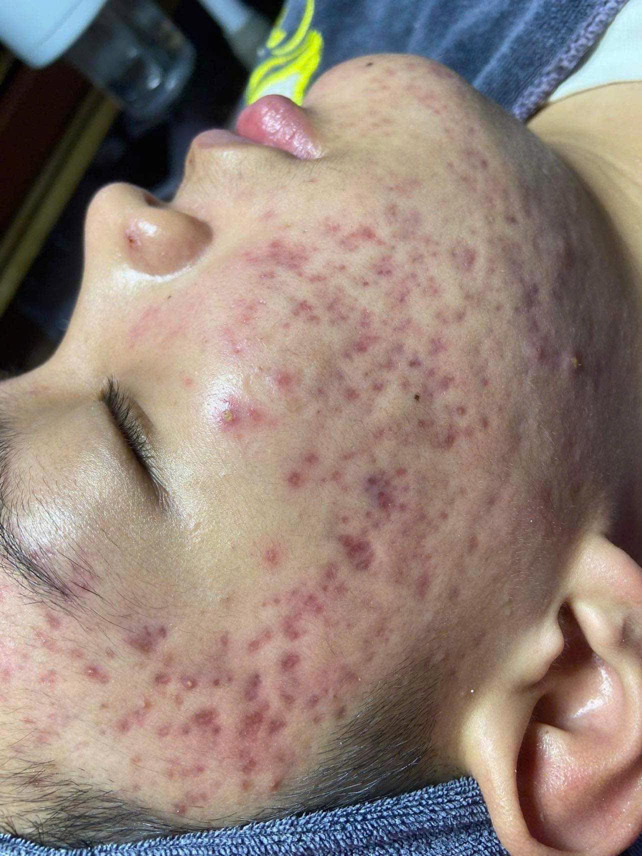 Cheek showing acne scarring before a skin rejuvenation care plan
